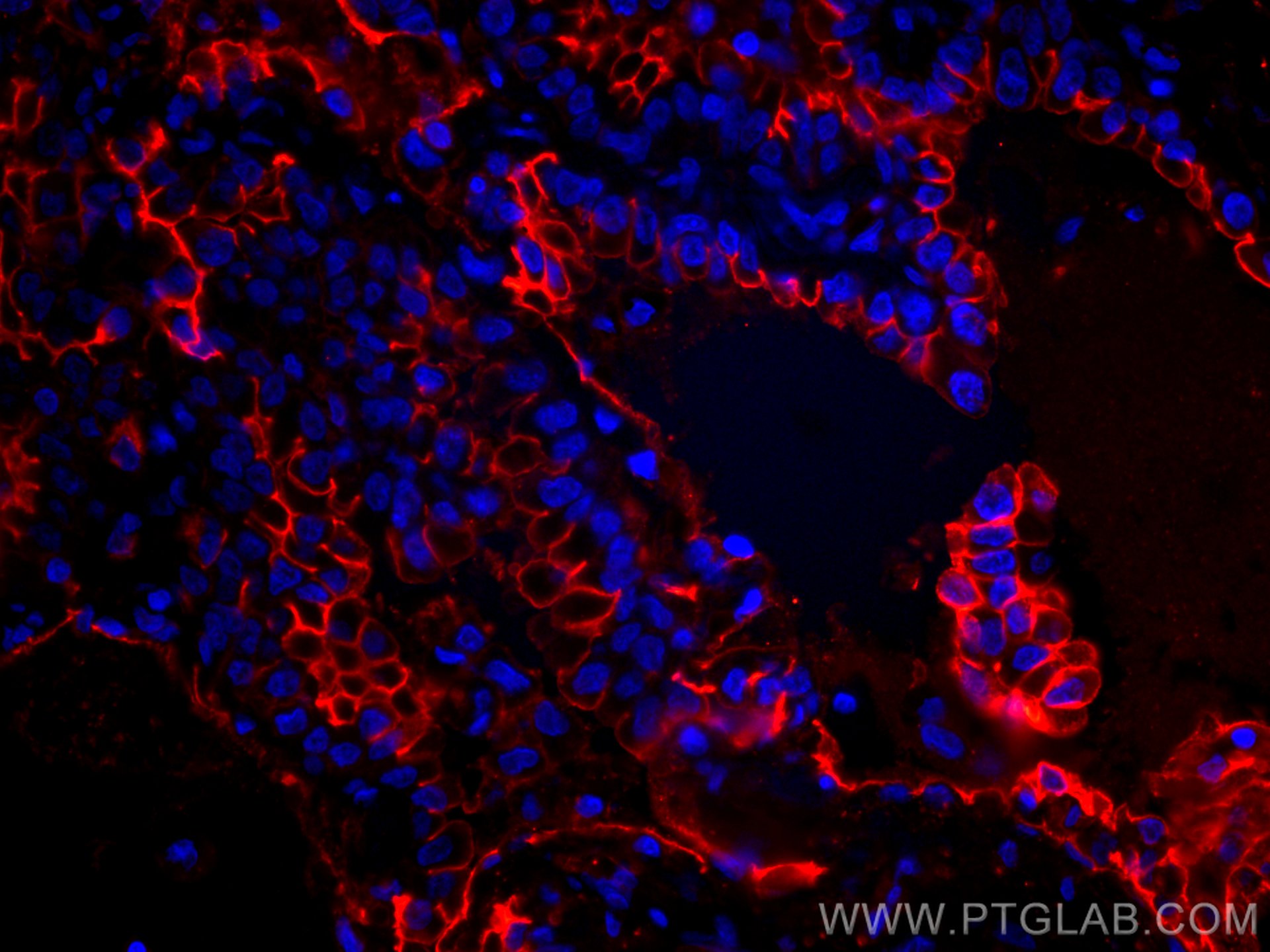 Immunofluorescence (IF) / fluorescent staining of human lung cancer tissue using CoraLite®594-conjugated ICAM-1 Polyclonal antibody (CL594-10831)