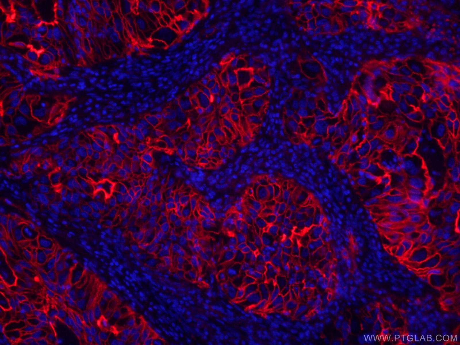 Immunofluorescence (IF) / fluorescent staining of human lung cancer tissue using CoraLite®594-conjugated ICAM-1 Monoclonal antibody (CL594-60299)