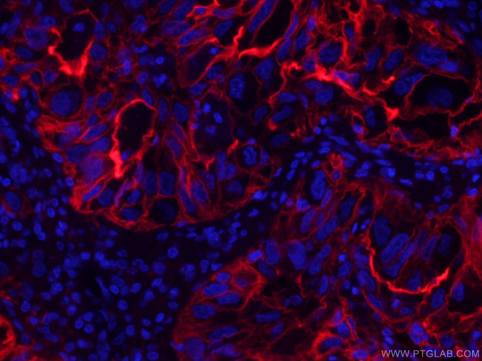 Immunofluorescence (IF) / fluorescent staining of human lung cancer tissue using CoraLite®594-conjugated ICAM-1 Monoclonal antibody (CL594-60299)