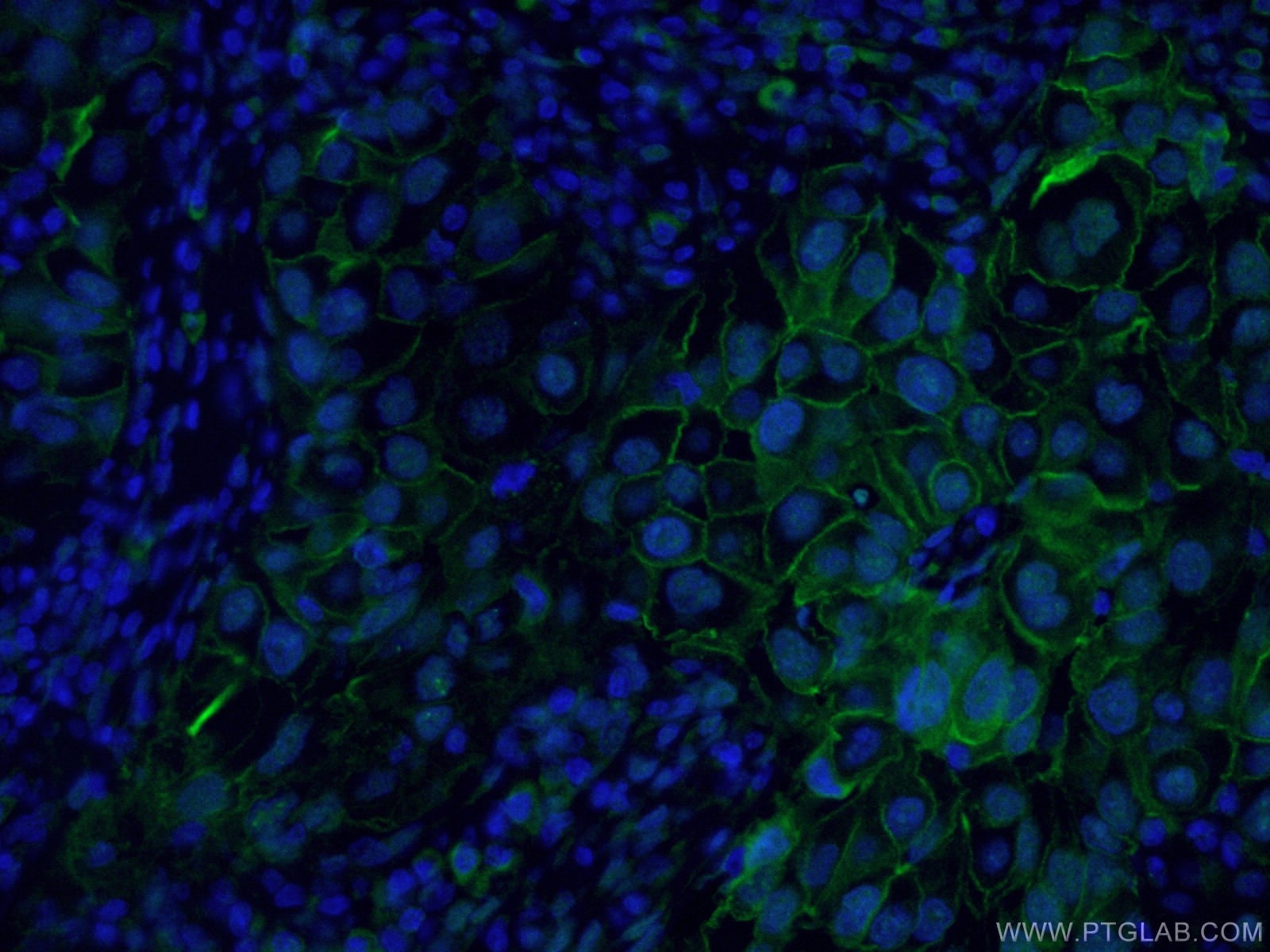 Immunofluorescence (IF) / fluorescent staining of human lung cancer tissue using FITC-conjugated ICAM-1 Monoclonal antibody (FITC-60299)