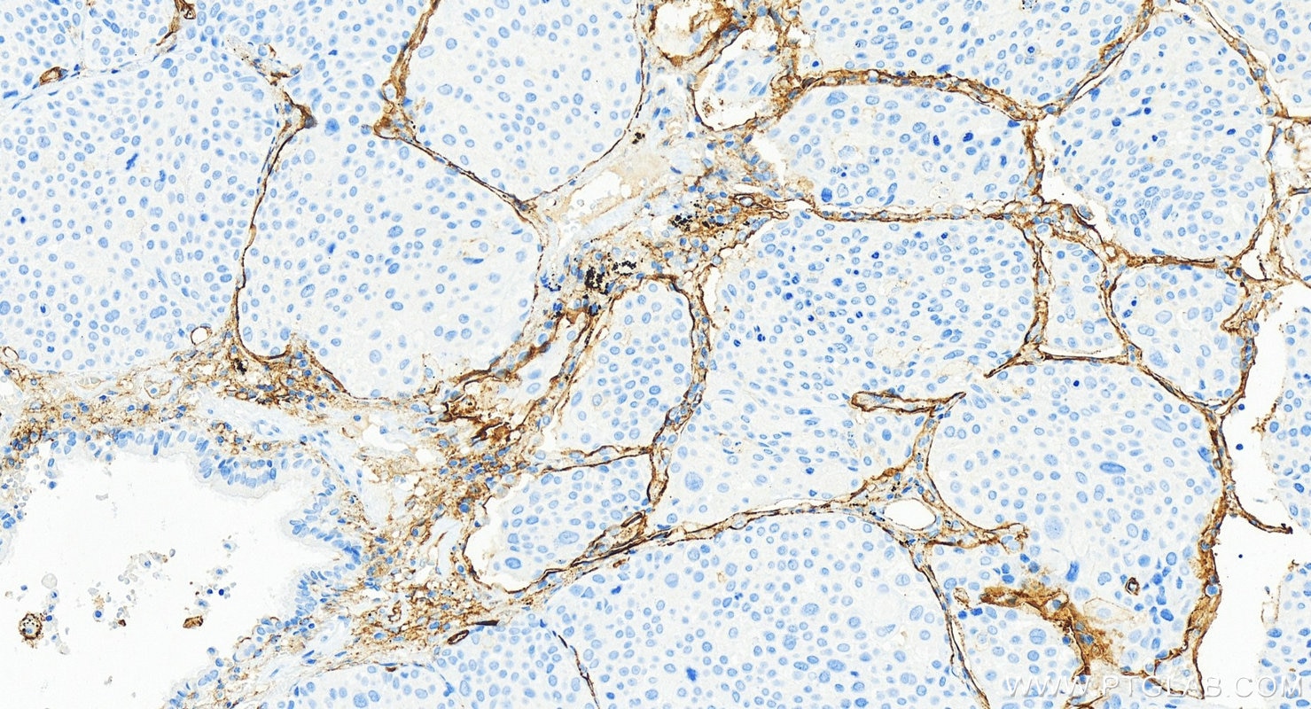 Immunohistochemistry (IHC) staining of human lung squamous cell carcinoma tissue using Multi-rAb® ICAM-1/CD54 Multi-Recombinant antibody (RMX00016)