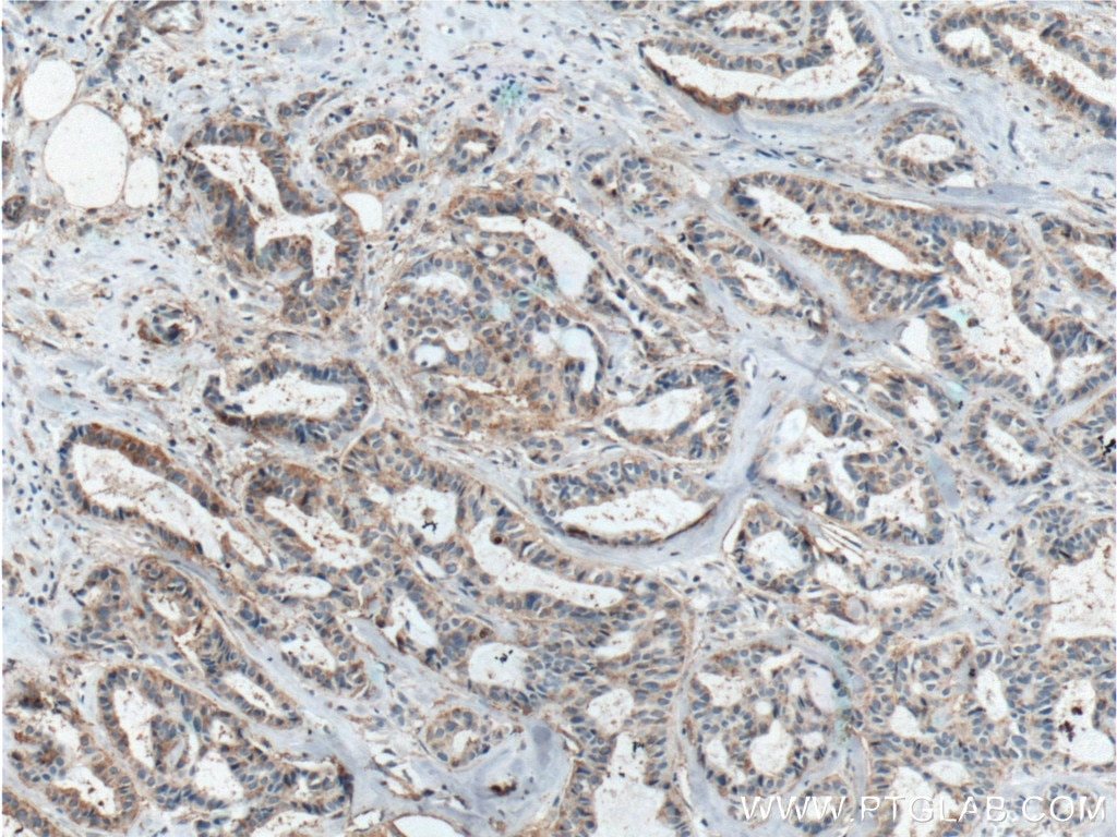 Immunohistochemistry (IHC) staining of human breast cancer tissue using ICAM2 Polyclonal antibody (10121-2-AP)