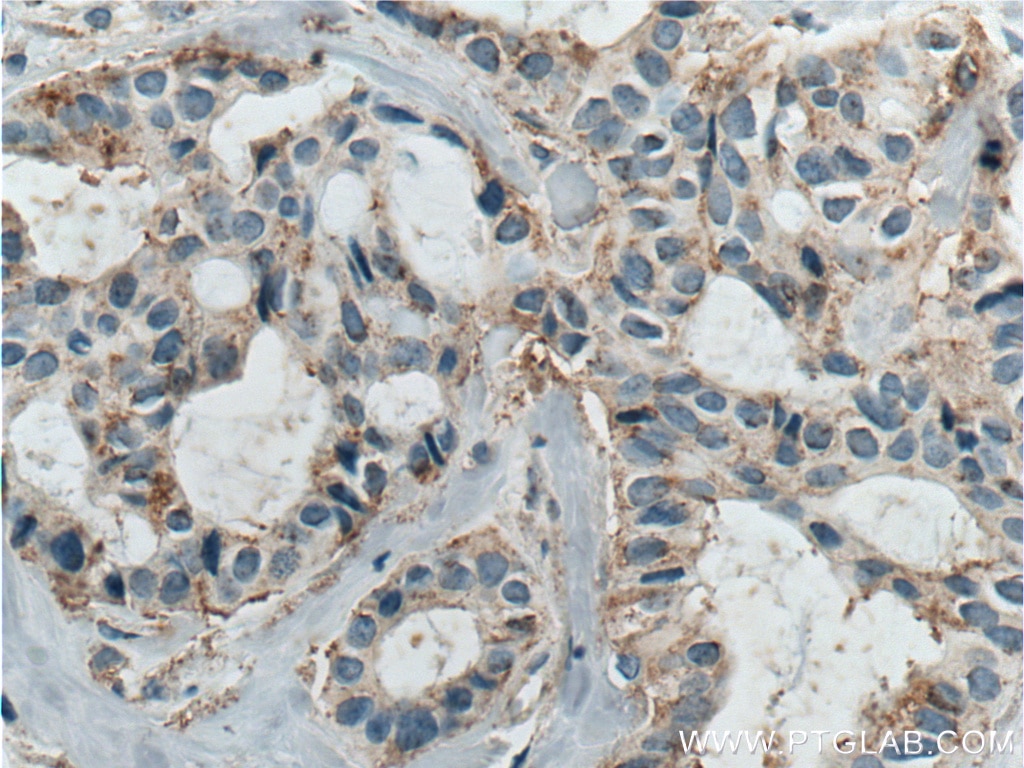 IHC staining of human breast cancer using 10121-2-AP