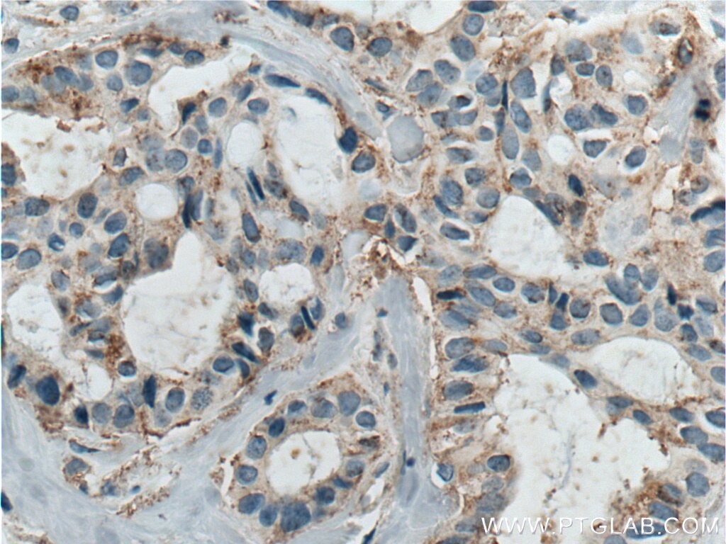 Immunohistochemistry (IHC) staining of human breast cancer tissue using ICAM2 Polyclonal antibody (10121-2-AP)