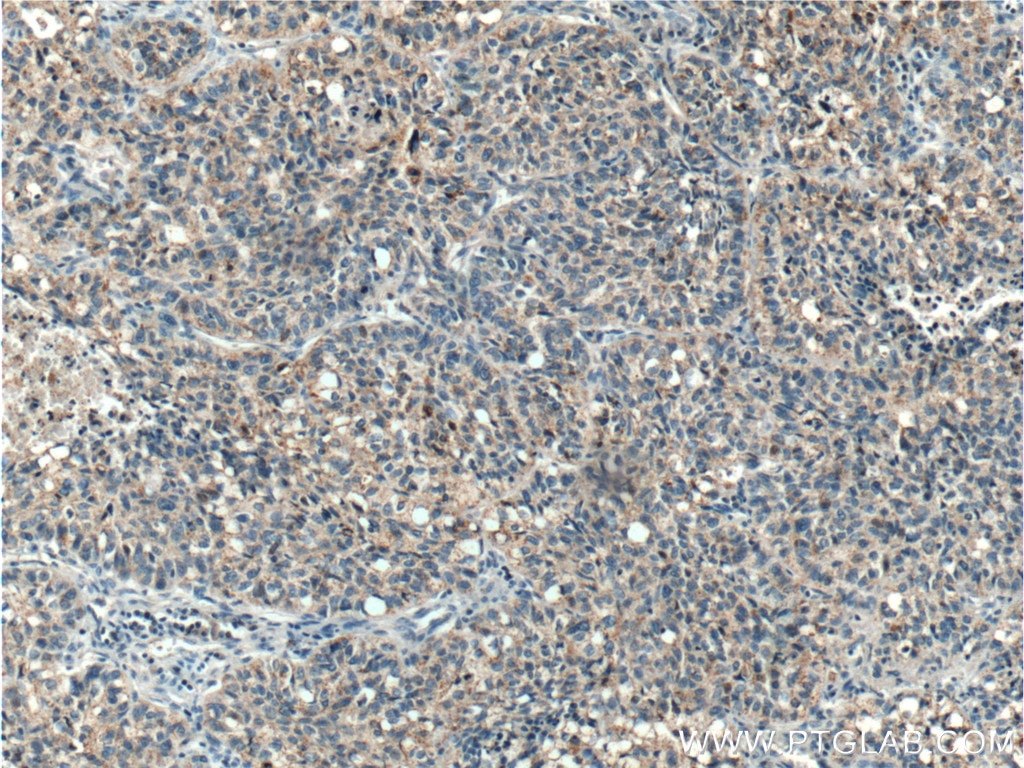 IHC staining of human lung cancer using 10121-2-AP