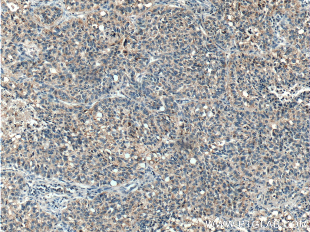 Immunohistochemistry (IHC) staining of human lung cancer tissue using ICAM2 Polyclonal antibody (10121-2-AP)