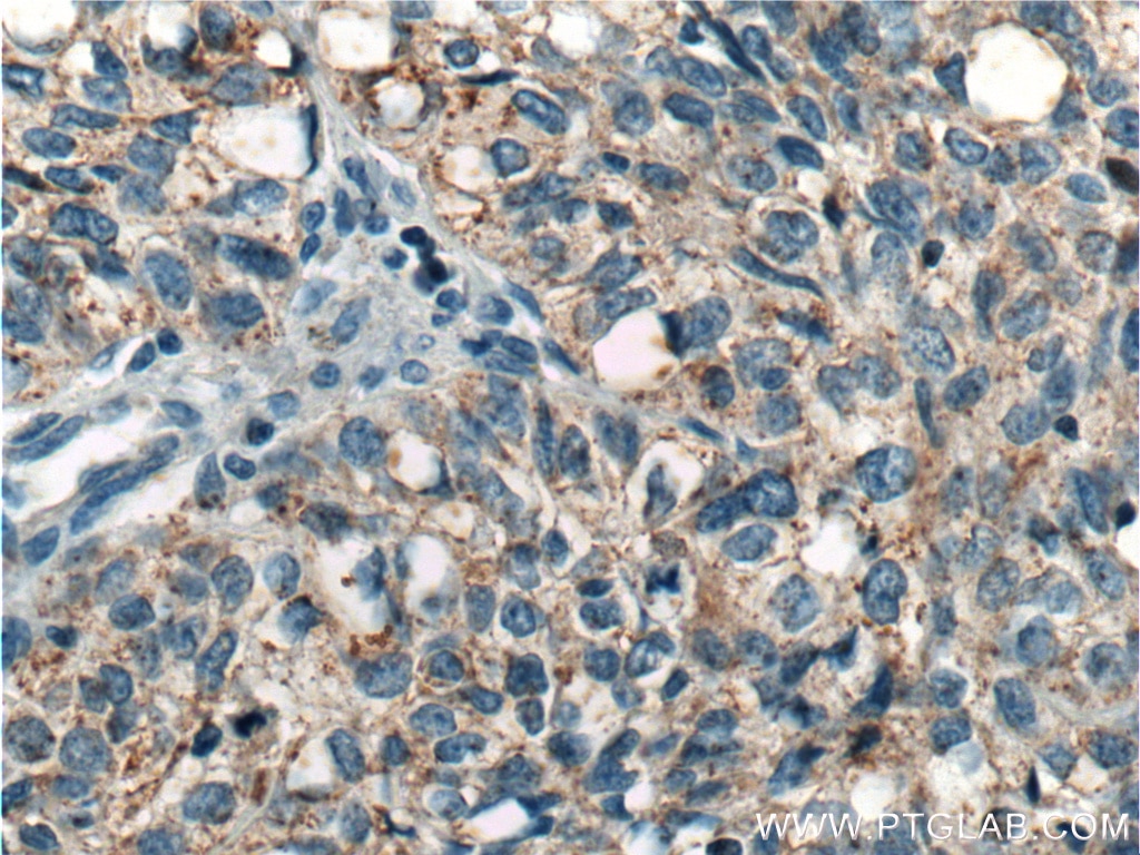 Immunohistochemistry (IHC) staining of human lung cancer tissue using ICAM2 Polyclonal antibody (10121-2-AP)