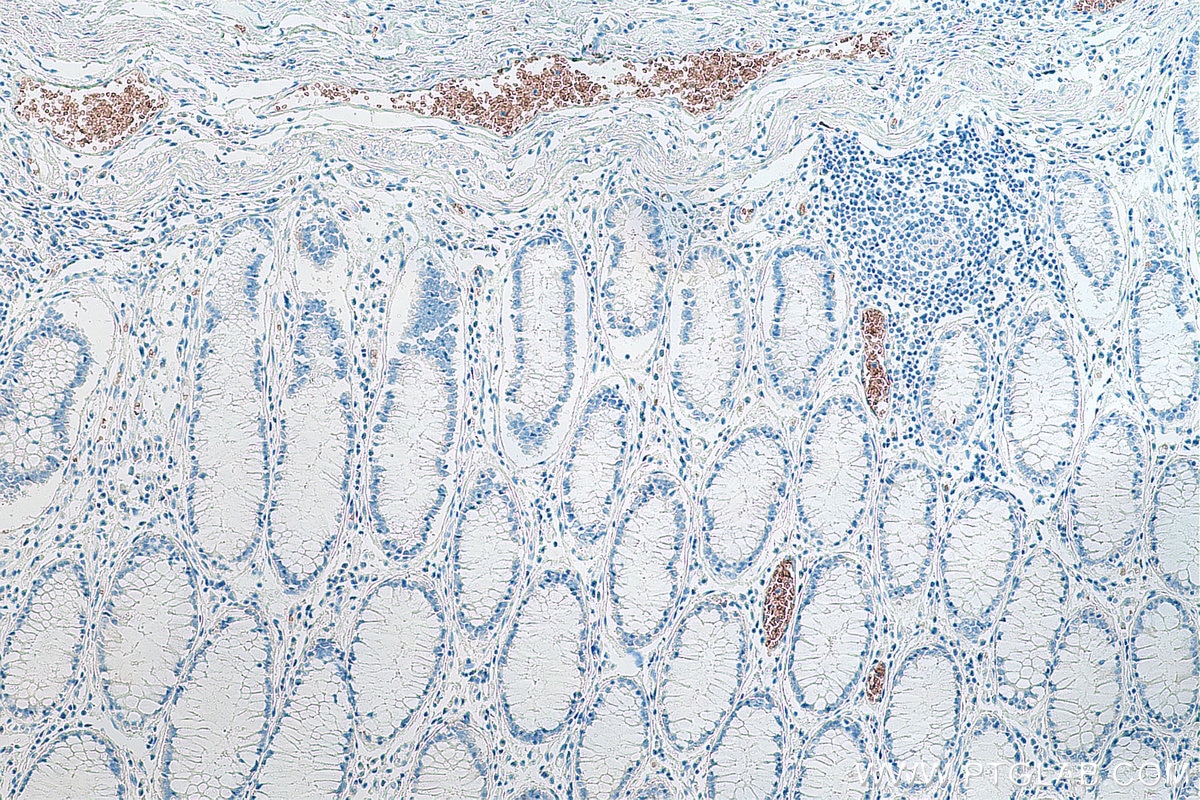Immunohistochemistry (IHC) staining of human colon cancer tissue using ICAM4 Monoclonal antibody (67014-1-Ig)