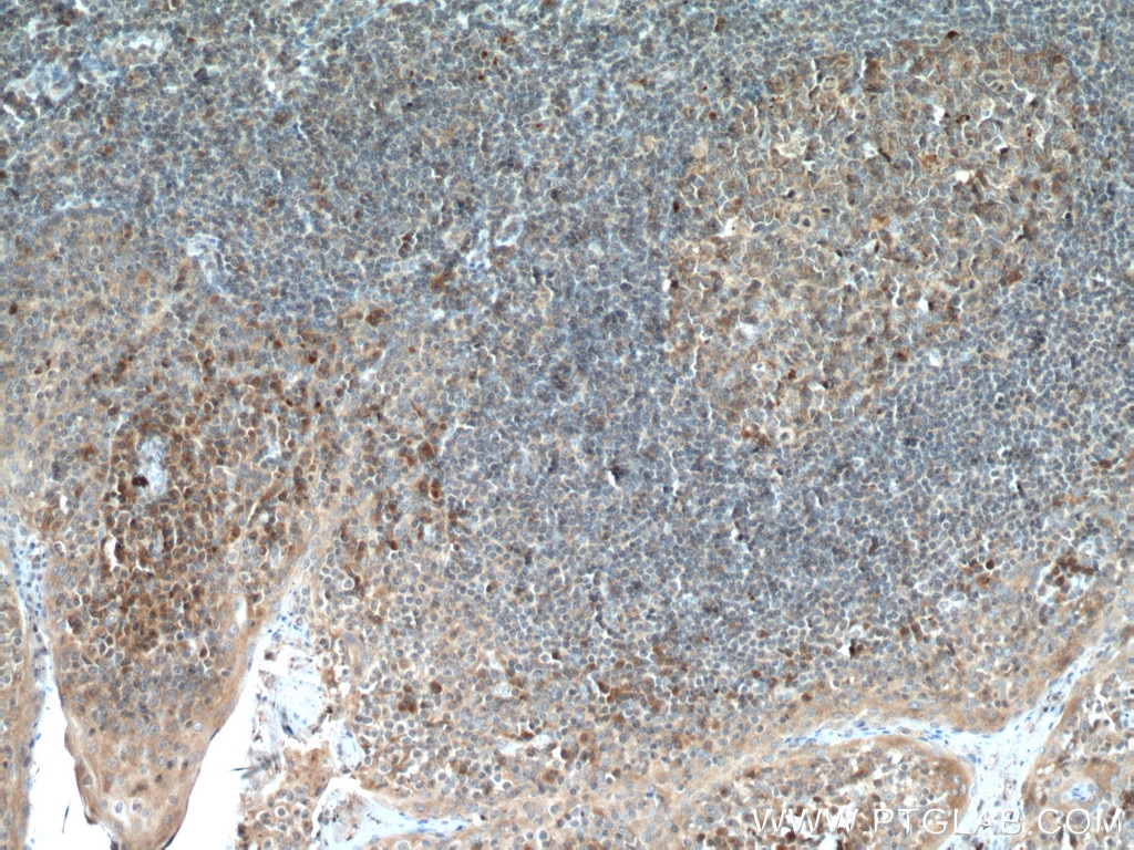 Immunohistochemistry (IHC) staining of human tonsillitis tissue using ICOSLG Polyclonal antibody (14922-1-AP)