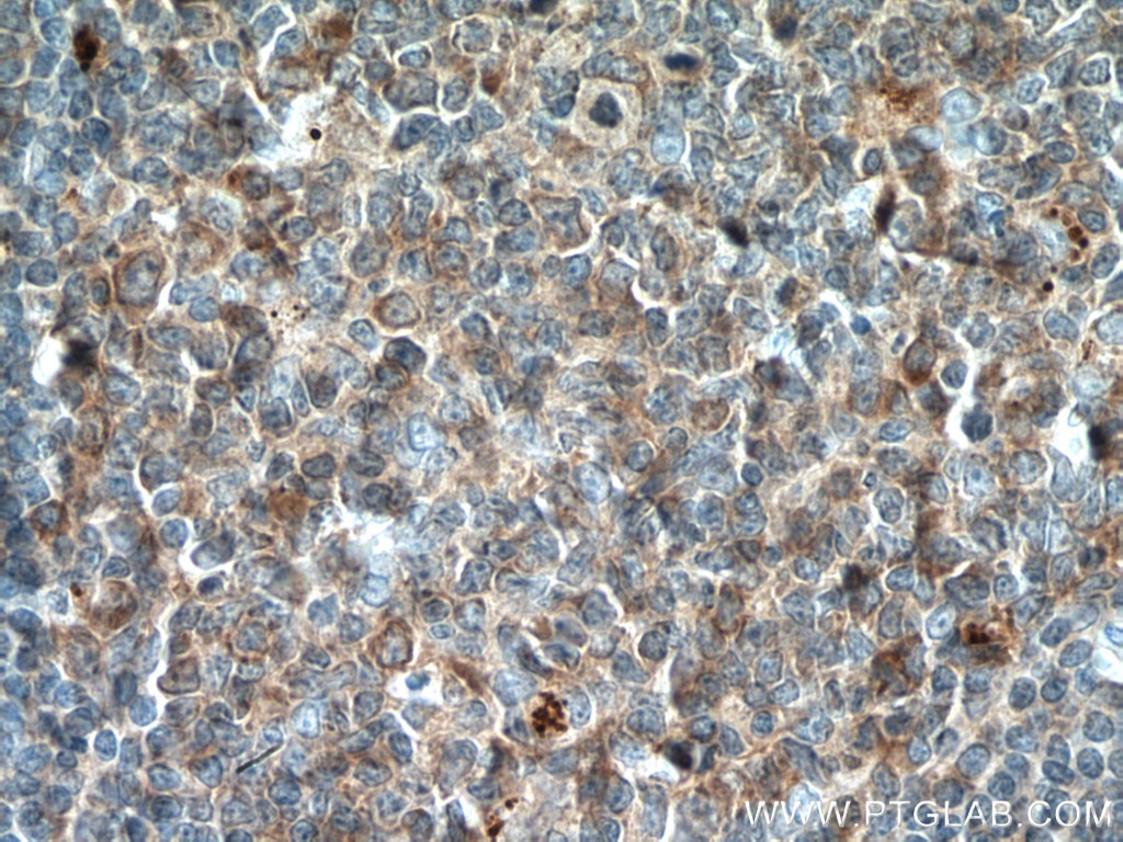 Immunohistochemistry (IHC) staining of human tonsillitis tissue using ICOSLG Polyclonal antibody (14922-1-AP)