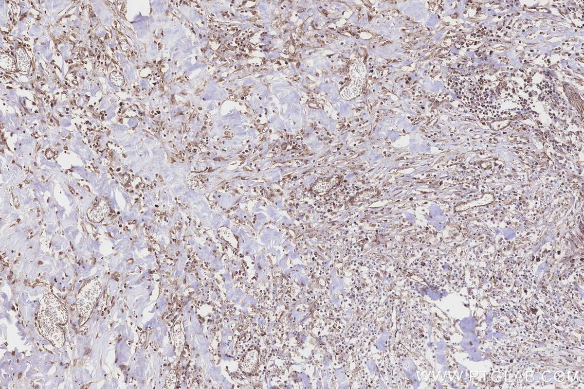 Immunohistochemistry (IHC) staining of human colon cancer tissue using ICT1 Polyclonal antibody (10403-1-AP)