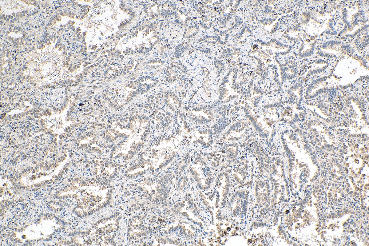 Immunohistochemistry (IHC) staining of human lung cancer tissue using ID1 Monoclonal antibody (67827-1-Ig)