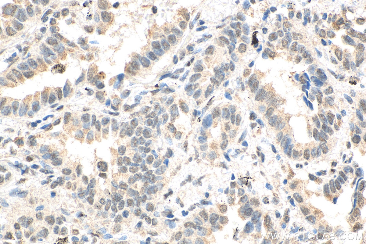 IHC staining of human lung cancer using 67827-1-Ig