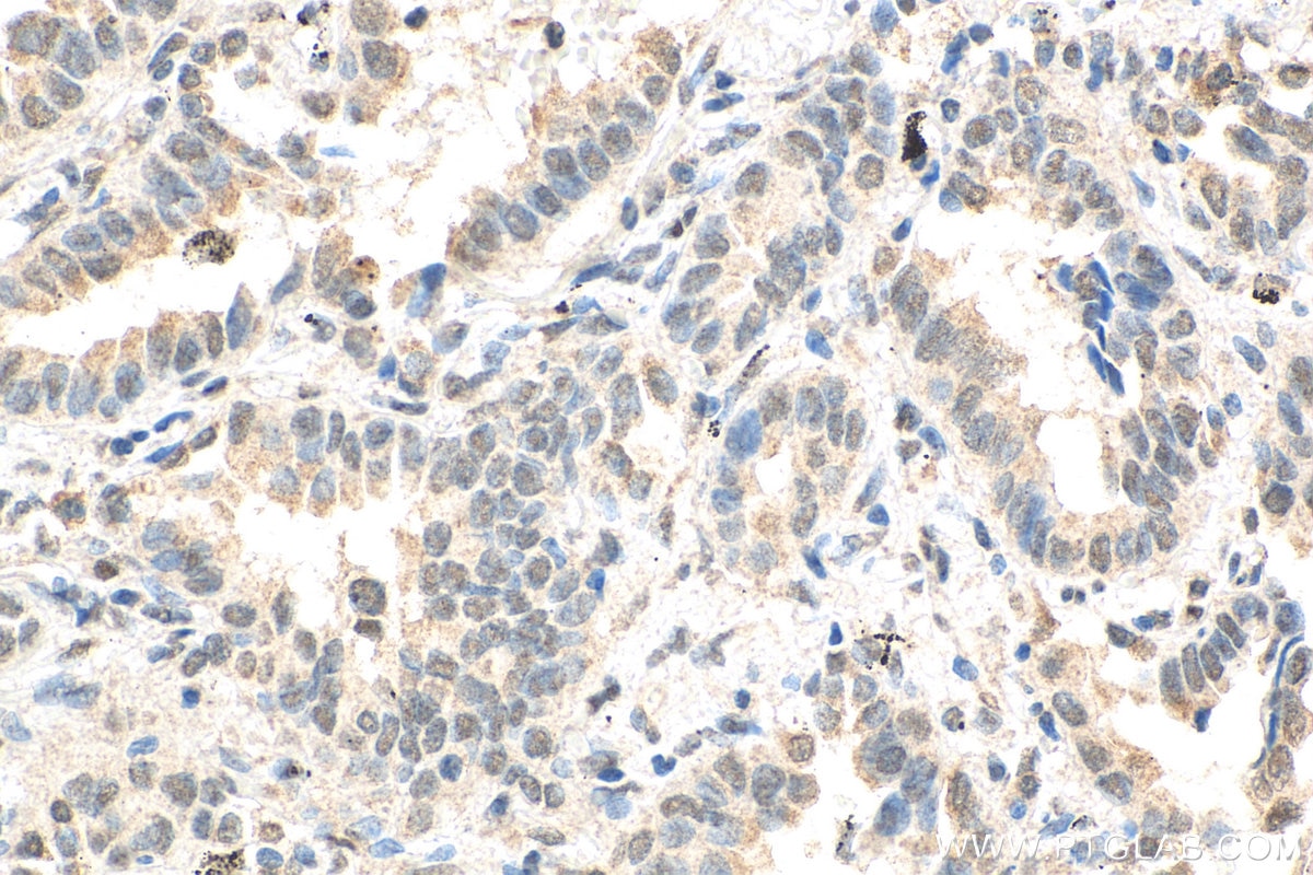 Immunohistochemistry (IHC) staining of human lung cancer tissue using ID1 Monoclonal antibody (67827-1-Ig)