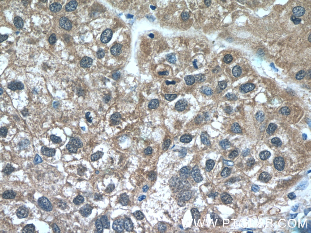 IHC staining of human liver cancer using 23309-1-AP