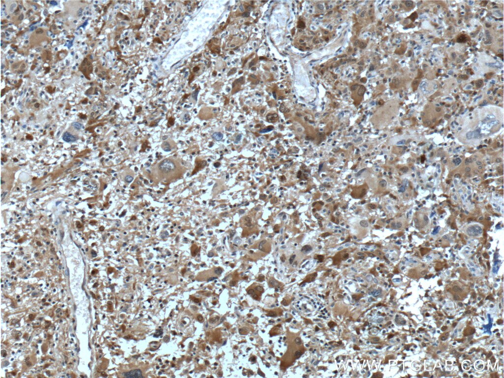 IHC staining of human gliomas using 66197-1-Ig