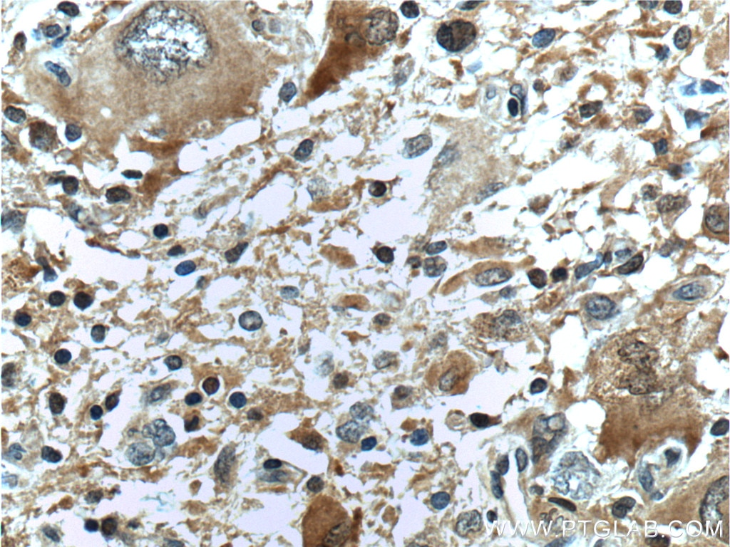 Immunohistochemistry (IHC) staining of human gliomas tissue using IDH1 Monoclonal antibody (66197-1-Ig)