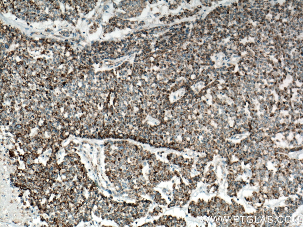 Immunohistochemistry (IHC) staining of human colon cancer tissue using IDH2 Polyclonal antibody (15932-1-AP)