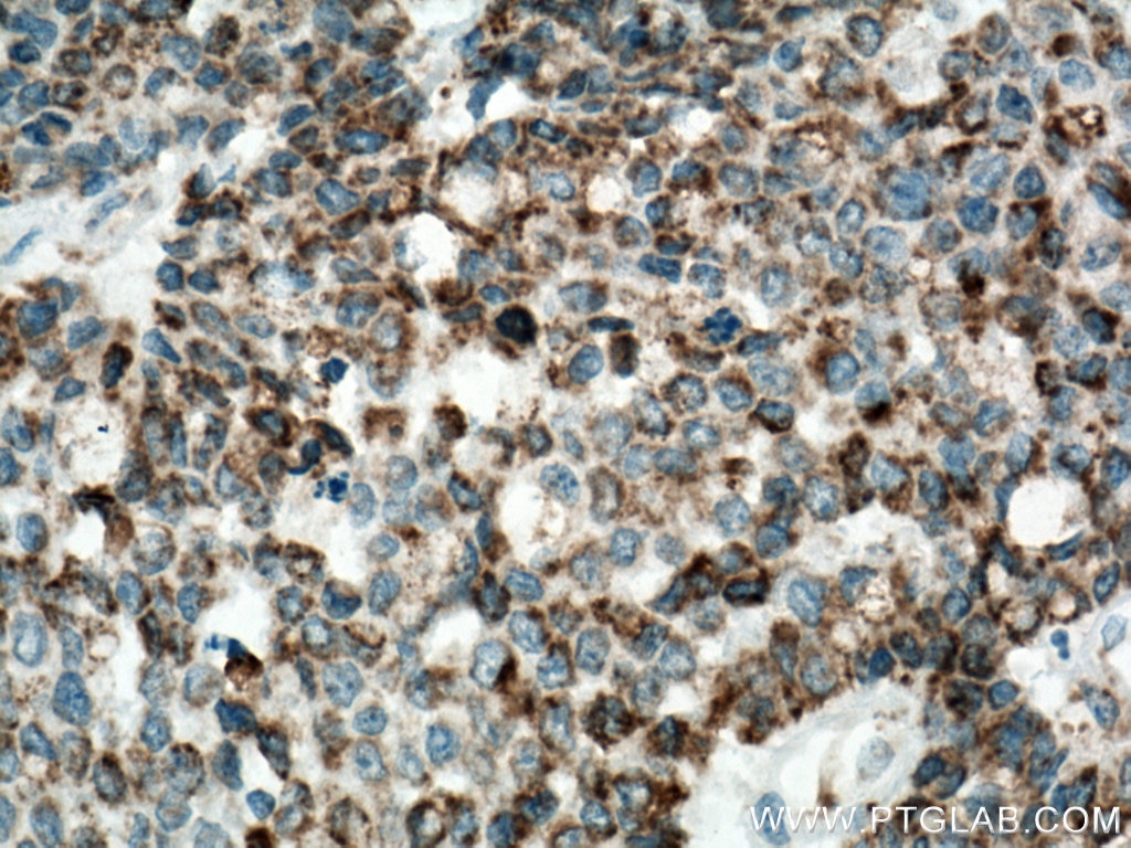 Immunohistochemistry (IHC) staining of human colon cancer tissue using IDH2 Polyclonal antibody (15932-1-AP)