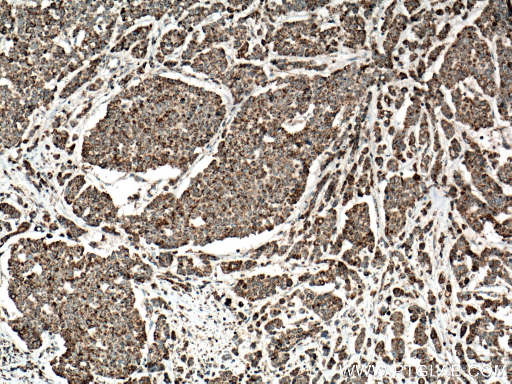 Immunohistochemistry (IHC) staining of human colon cancer tissue using IDH2 Polyclonal antibody (15932-1-AP)