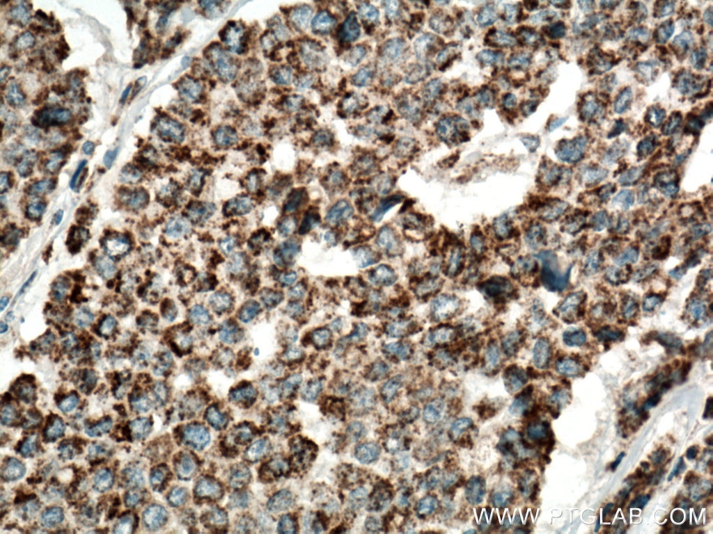 Immunohistochemistry (IHC) staining of human colon cancer tissue using IDH2 Polyclonal antibody (15932-1-AP)