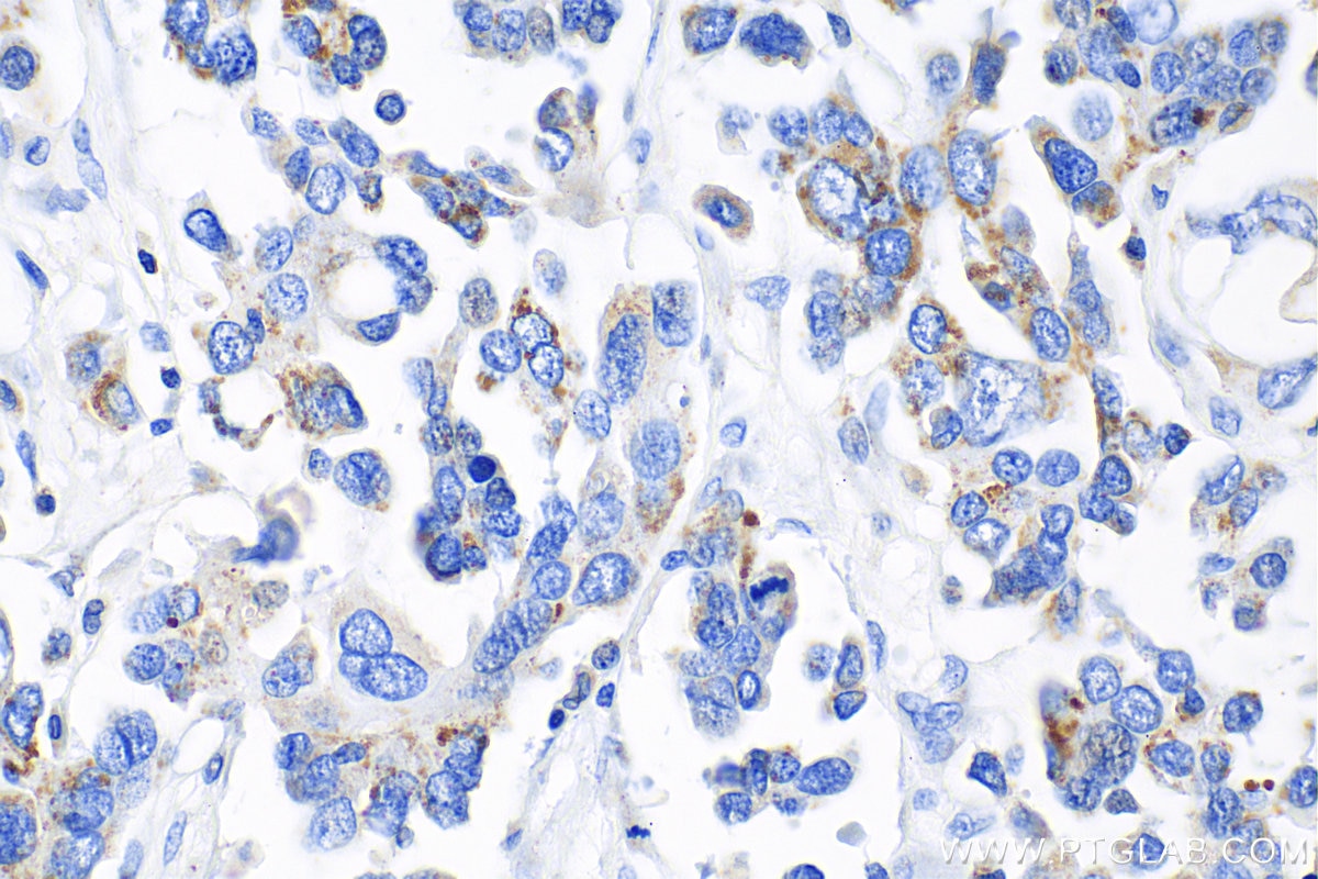 Immunohistochemistry (IHC) staining of human colon cancer tissue using IDH2 Recombinant antibody (82117-1-RR)