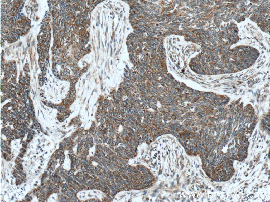 Immunohistochemistry (IHC) staining of human skin cancer tissue using IDH3G Polyclonal antibody (25848-1-AP)