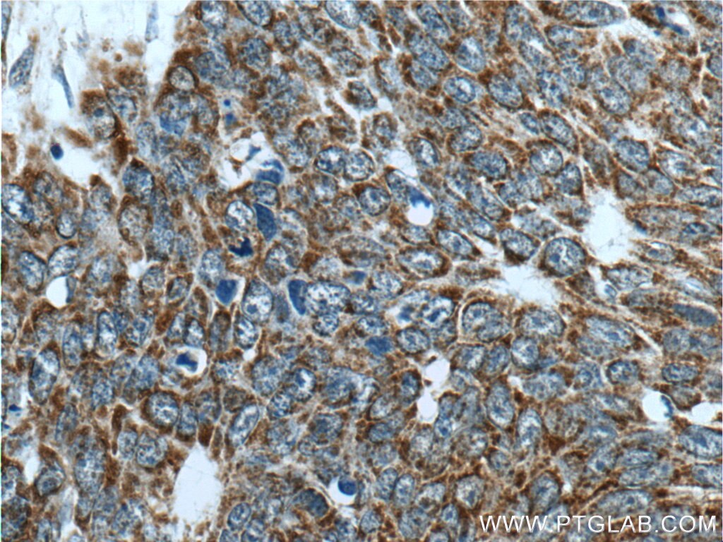 Immunohistochemistry (IHC) staining of human skin cancer tissue using IDH3G Polyclonal antibody (25848-1-AP)