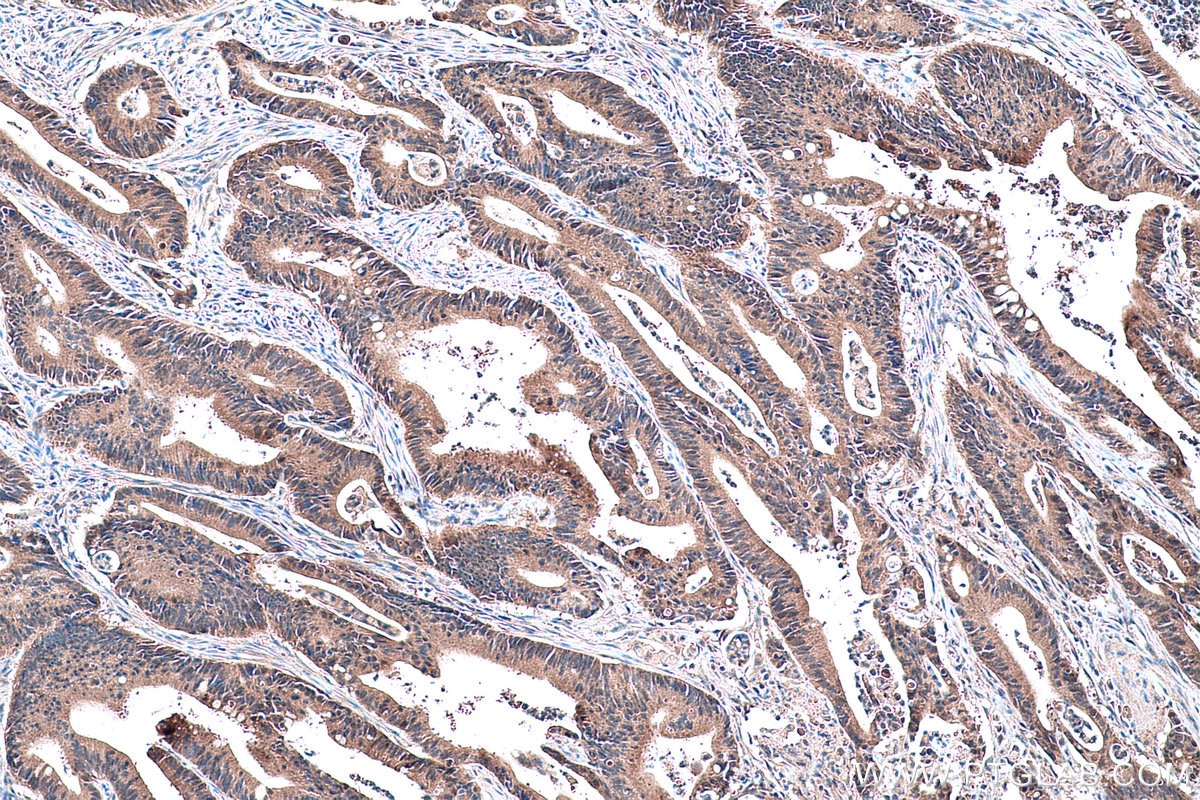 Immunohistochemistry (IHC) staining of human colon cancer tissue using IDI1 Polyclonal antibody (11166-2-AP)