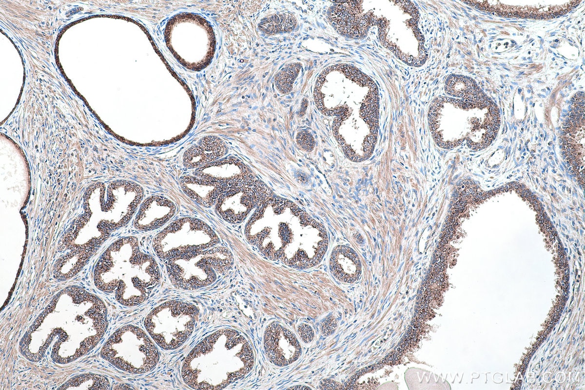 Immunohistochemistry (IHC) staining of human prostate cancer tissue using IDI1 Polyclonal antibody (11166-2-AP)