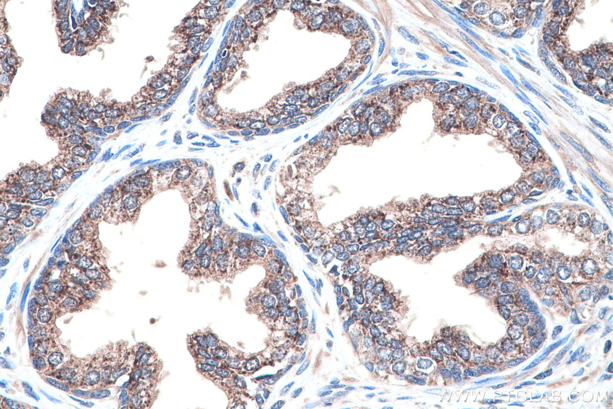 Immunohistochemistry (IHC) staining of human prostate cancer tissue using IDI1 Polyclonal antibody (11166-2-AP)