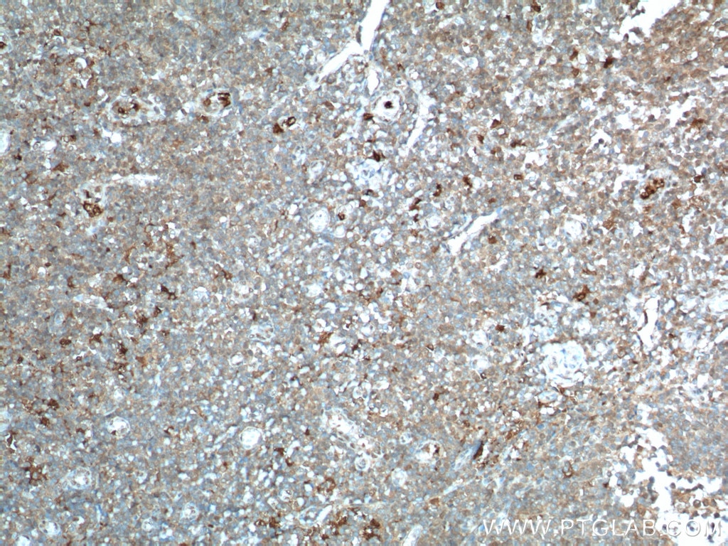 Immunohistochemistry (IHC) staining of human tonsillitis tissue using IDO1 Polyclonal antibody (13268-1-AP)