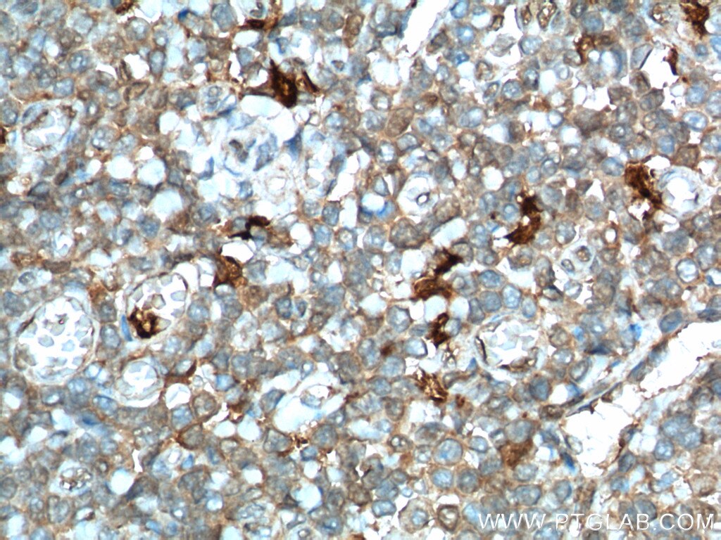 Immunohistochemistry (IHC) staining of human tonsillitis tissue using IDO1 Polyclonal antibody (13268-1-AP)