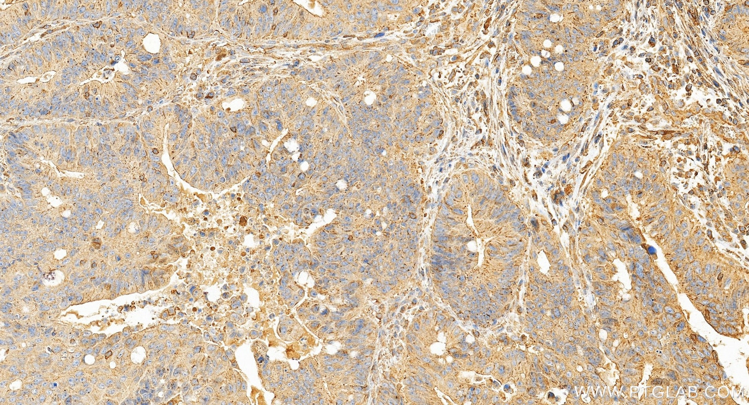 Immunohistochemistry (IHC) staining of human colon cancer tissue using IDO1 Monoclonal antibody (66528-1-Ig)