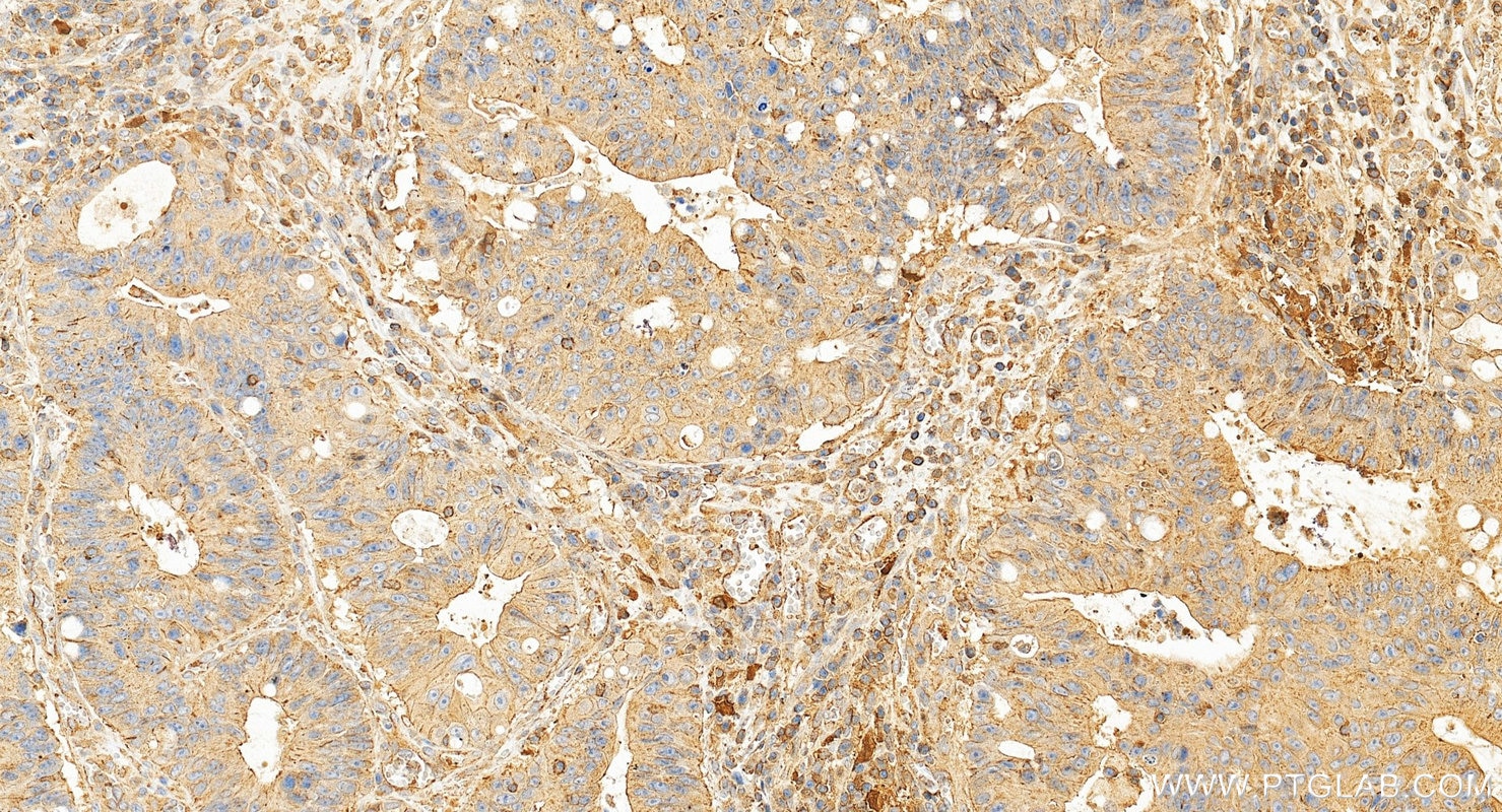 Immunohistochemistry (IHC) staining of human colon cancer tissue using IDO1 Monoclonal antibody (66528-1-Ig)
