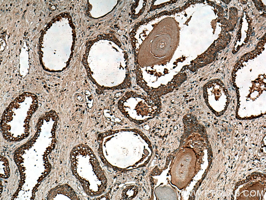 Immunohistochemistry (IHC) staining of human prostate cancer tissue using IDUA Polyclonal antibody (55158-1-AP)
