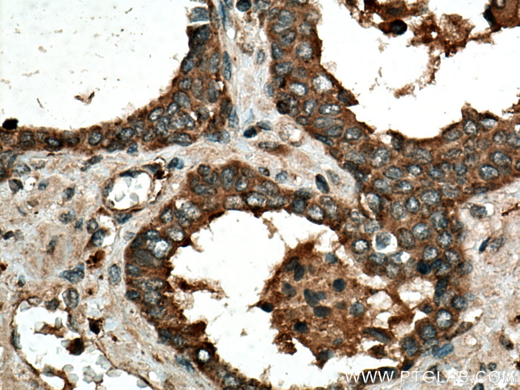 Immunohistochemistry (IHC) staining of human prostate cancer tissue using IDUA Polyclonal antibody (55158-1-AP)