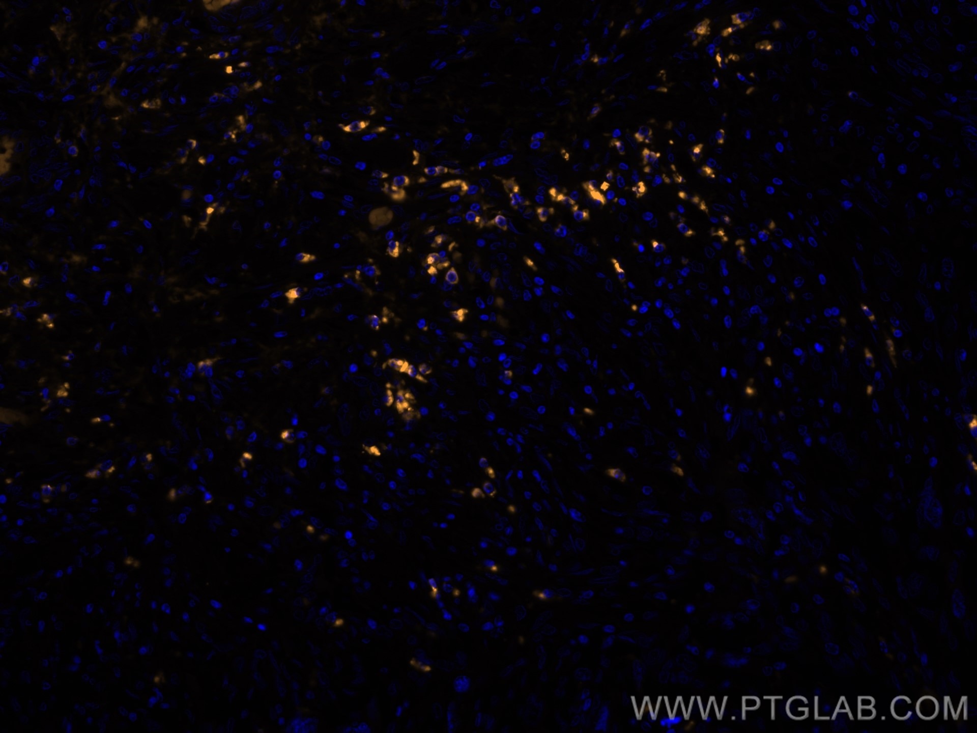 Immunofluorescent analysis of (4% PFA) fixed human lung cancer using FlexAble HRP Antibody Labeling Kit for Human IgG (KFA110) and Tyramide-555(orange) to label endogenous human IgG in the tissue.