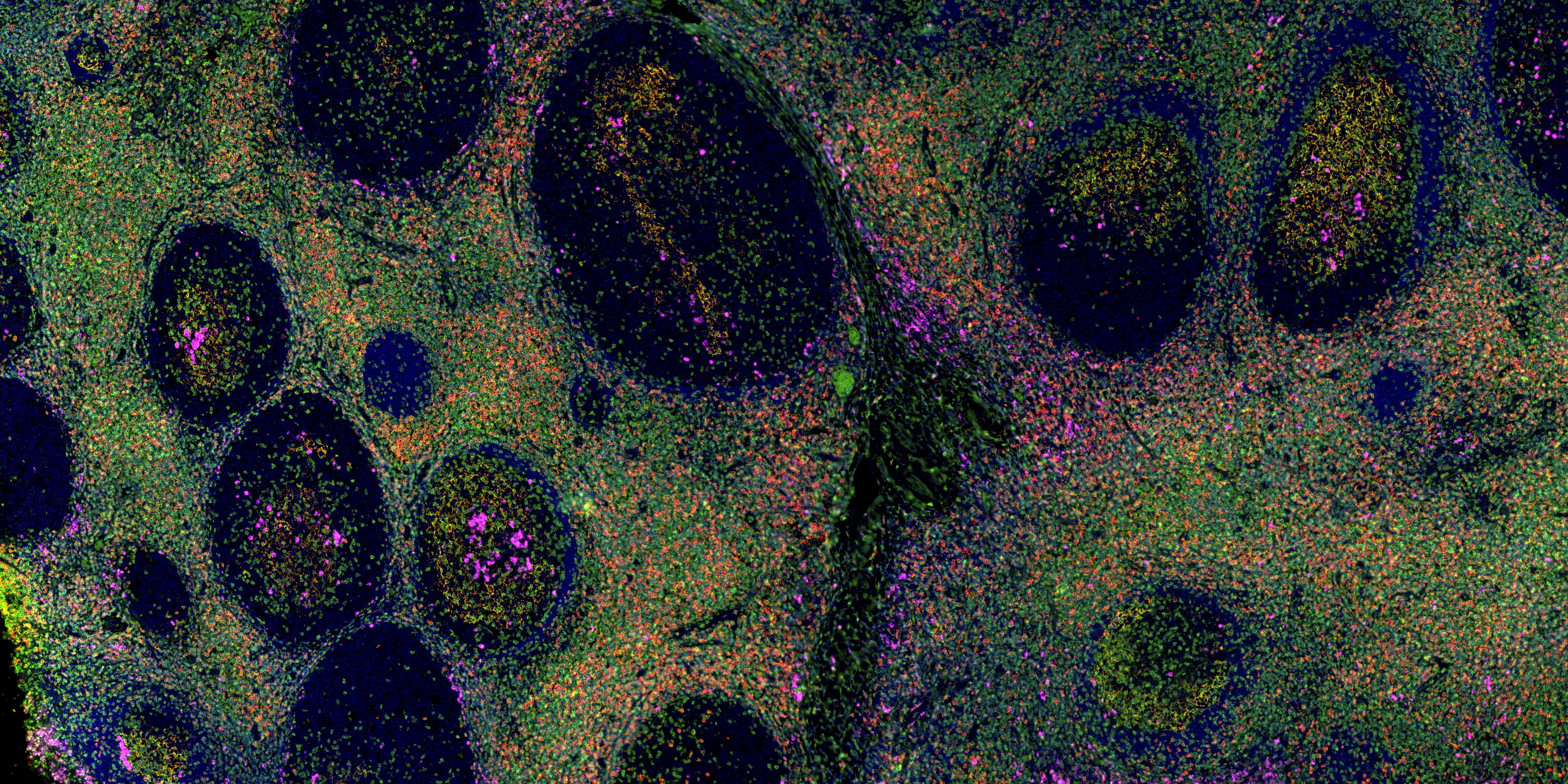IF staining using using PK10034 (Five color TSA Detect Kit for Rabbit/Mouse Primary Antibody).
FFPE-human tonsillitis tissue was stained with CD23 monoclonal antibody (60208-2-Ig) at 1:8000 followed by detection with Multi-rAb® Polymer HRP-Goat Anti-Rabbit/Mouse Universal Recombinant Secondary Antibody (H+L). CoraLite®Plus 555-Tyramide Reagent was used for signal development (yellow). The slide was then conducted HIER in pH 9.0 Tris-EDTA buffer followed by staining with CD3 monoclonal antibody (60181-1-Ig, 1:10000). CoraLite®Plus 488-Tyramide Reagent were used for signal development (green). Similarly, CD8a monoclonal antibody (66868-1-Ig, 1:20000) and CD138 monoclonal antibody (67155-1-Ig, 1:10000) were stained subsequently. CoraLite®Plus 594-Tyramide Reagent (red) and CoraLite®Plus 647-Tyramide Reagent (purple) were used for signal development respectively. Finally, cell nucleus (blue) were stained with DAPI. The signal from each channel was captured and merged.