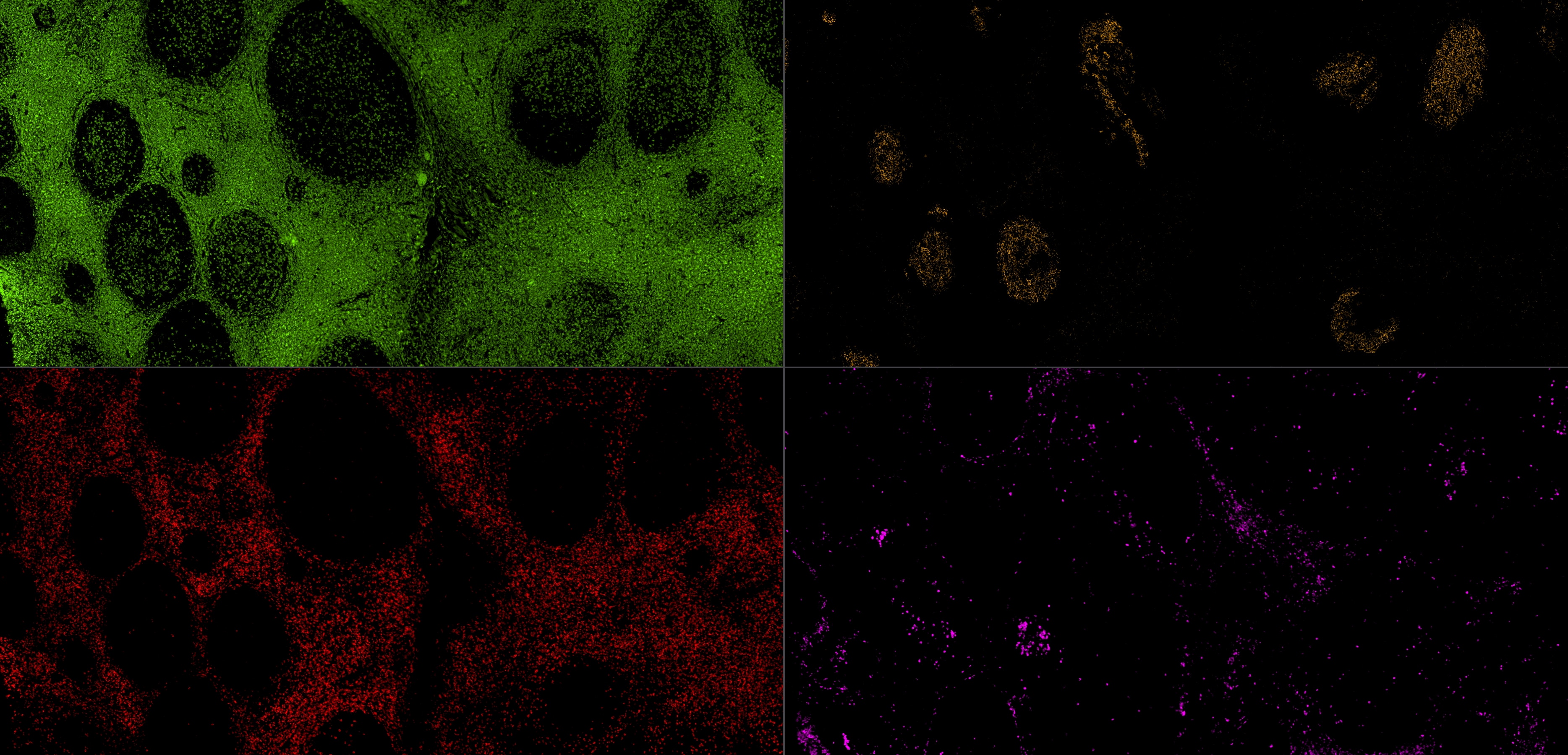 IF staining using using PK10034 (Five color TSA Detect Kit for Rabbit/Mouse Primary Antibody).
FFPE-human tonsillitis tissue was stained with CD23 monoclonal antibody (60208-2-Ig) at 1:8000 followed by detection with Multi-rAb® Polymer HRP-Goat Anti-Rabbit/Mouse Universal Recombinant Secondary Antibody (H+L). CoraLite®Plus 555-Tyramide Reagent was used for signal development (yellow). The slide was then conducted HIER in pH 9.0 Tris-EDTA buffer followed by staining with CD3 monoclonal antibody (60181-1-Ig, 1:10000). CoraLite®Plus 488-Tyramide Reagent were used for signal development (green). Similarly, CD8a monoclonal antibody (66868-1-Ig, 1:20000) and CD138 monoclonal antibody (67155-1-Ig, 1:10000) were stained subsequently. CoraLite®Plus 594-Tyramide Reagent (red) and CoraLite®Plus 647-Tyramide Reagent (purple) were used for signal development respectively. Finally, cell nucleus (blue) were stained with DAPI.