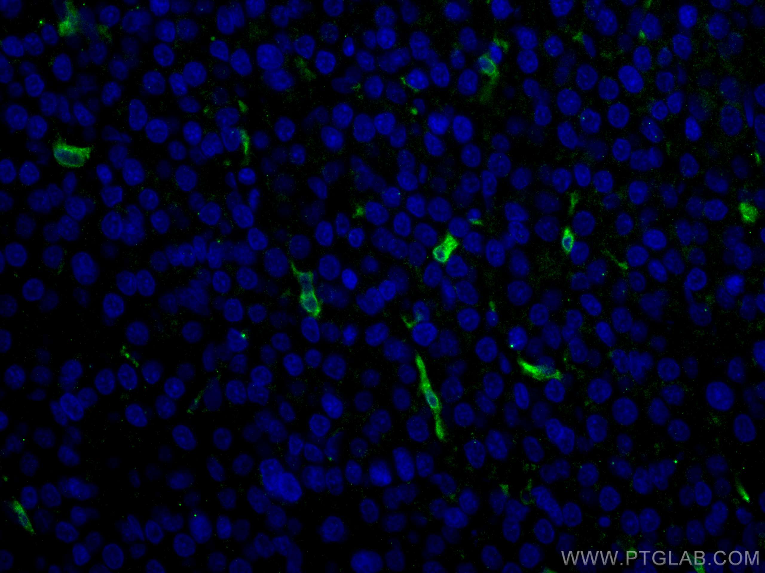 Immunofluorescent analysis of (4% PFA) fixed human liver cancer tissue using HO-1/HMOX1 antibody (10701-1-AP) at dilution of 1:400 and CoraLite®488-Conjugated AffiniPure Goat Anti-Rabbit IgG(H+L).