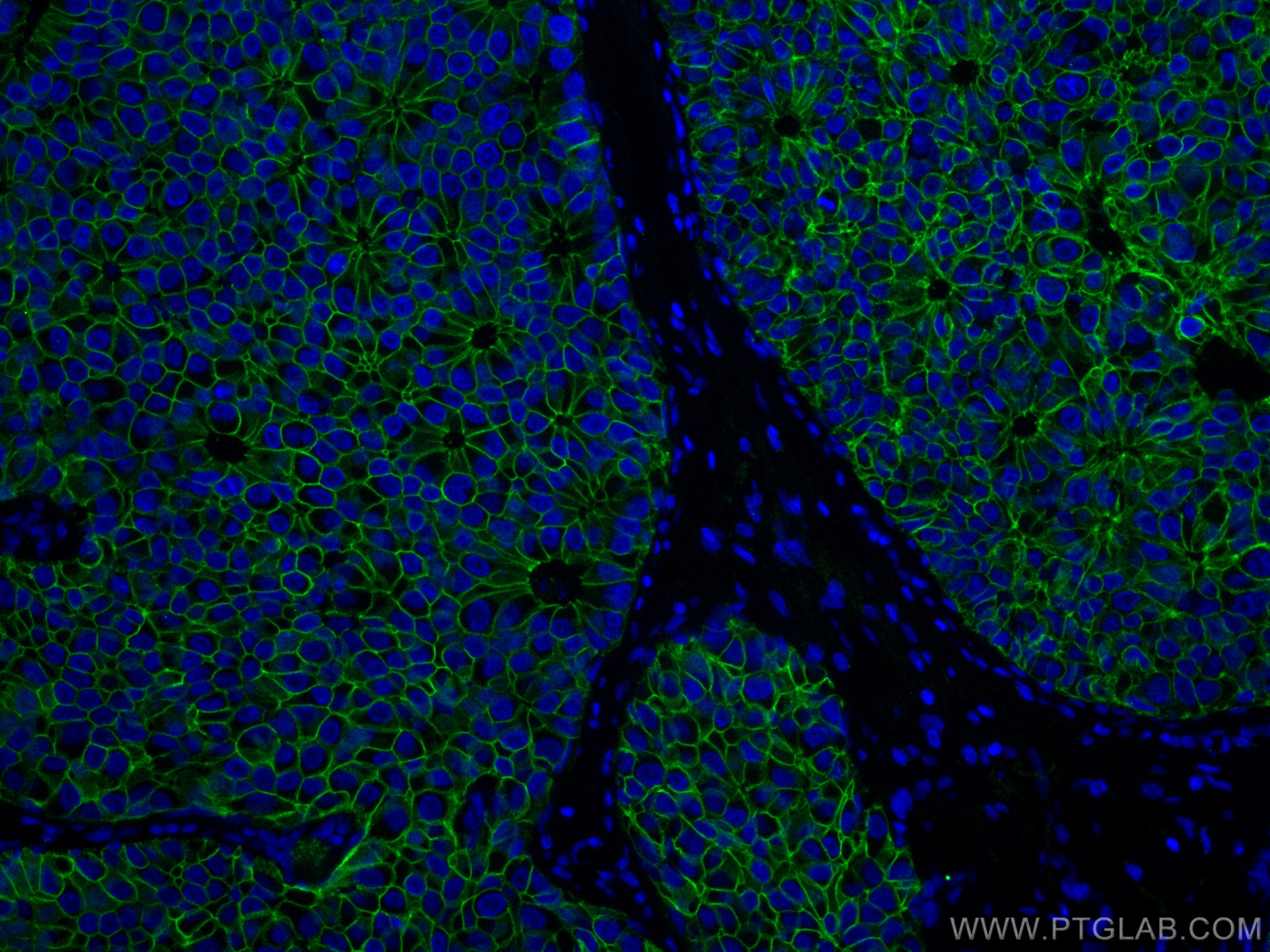 Immunofluorescent analysis of (4% PFA) fixed human breast cancer tissue using E-cadherin antibody (60335-1-Ig, Clone: 6B11F11 ) at dilution of 1:400 and CoraLite®488-Conjugated AffiniPure Goat Anti-Mouse IgG(H+L).