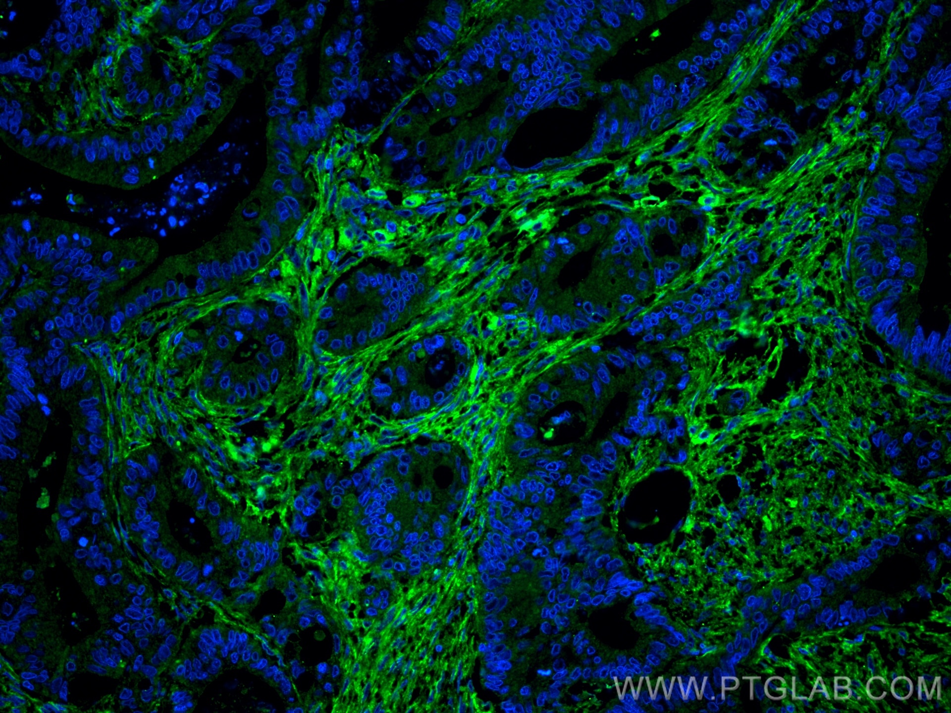 Immunofluorescent analysis of (4% PFA) fixed human colon cancer tissue using Fibronectin antibody (66042-1-Ig, Clone: 1G10F9 ) at dilution of 1:400 and CoraLite®488-Conjugated AffiniPure Goat Anti-Mouse IgG(H+L).