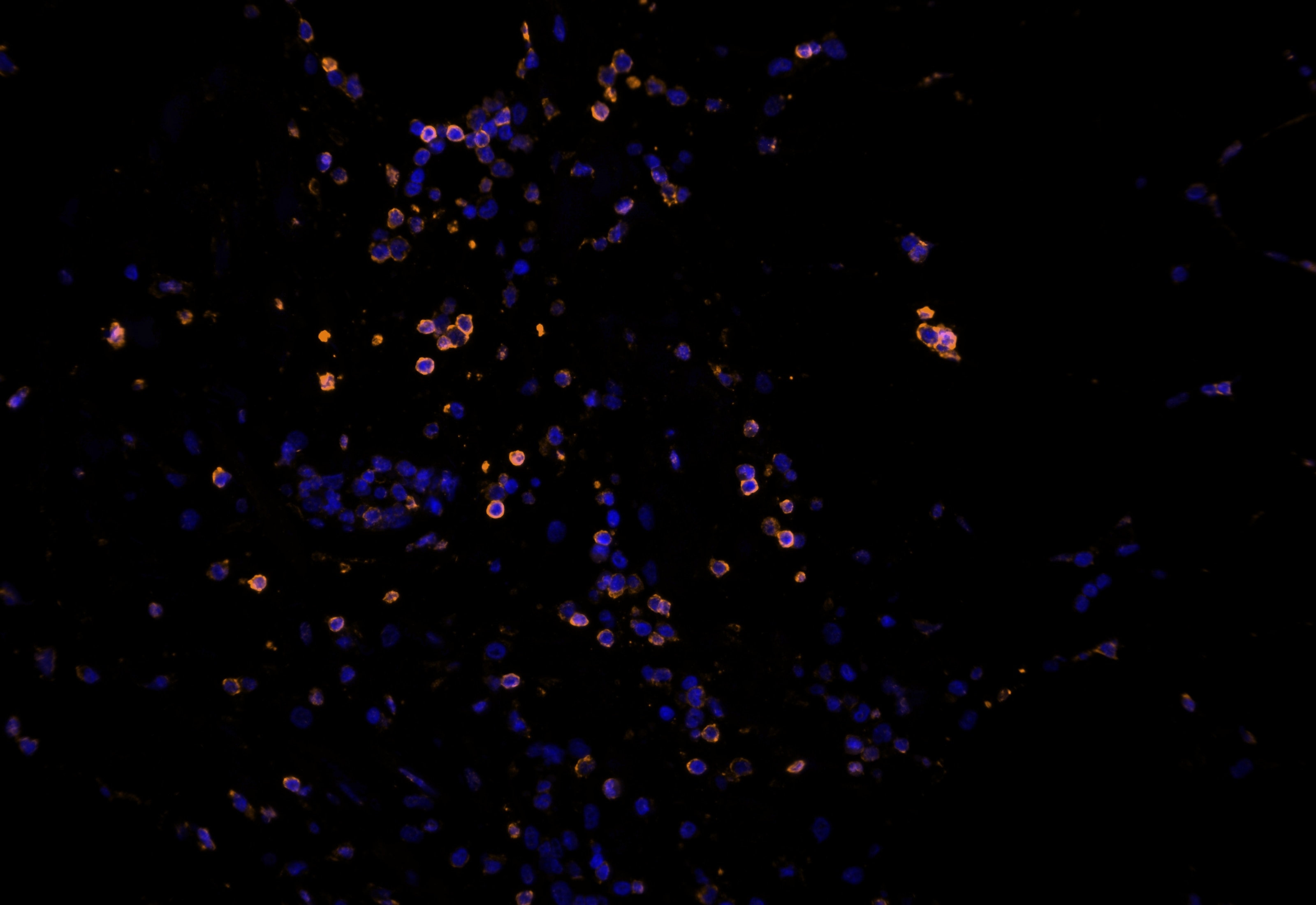 IF Staining using CoraLite®Plus 555-Tyramide Reagent PR30023. 
FFPE-human appendicitis tissue was stained with 65150-1-Ig (CD45RO Monoclonal antibody) at 1:10000 followed by detection with Multi-rAb® Polymer HRP-Goat Anti-Rabbit/Mouse Universal Recombinant Secondary Antibody (H+L) (Cat.NO. RGAU011). CoraLite®Plus 555-Tyramide Reagent (Cat.NO. PR30023) was used for signal development. Cell nucleus (blue) was stained with DAPI.