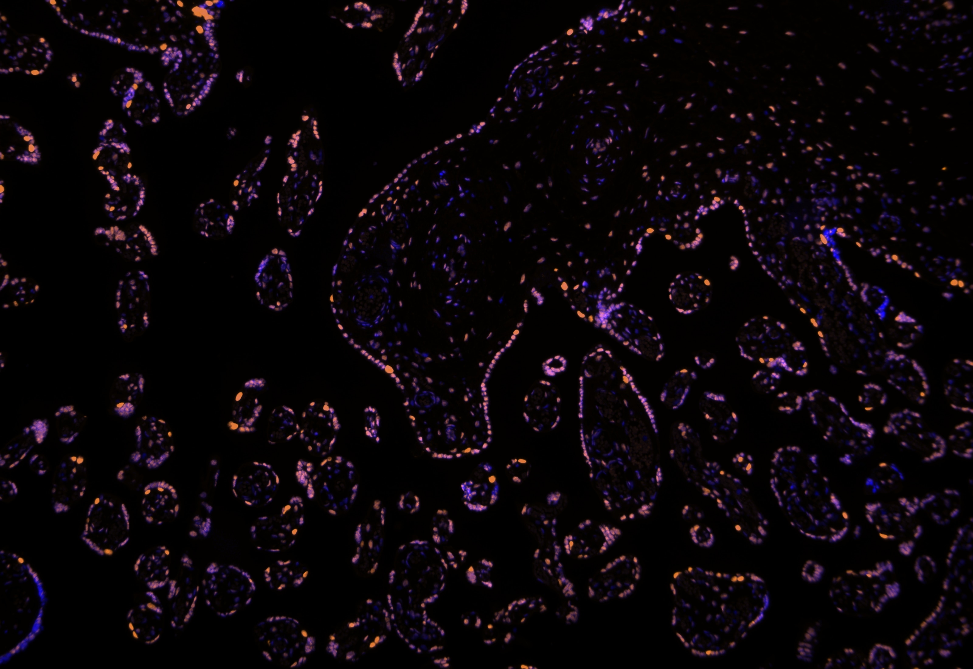 IF Staining using CoraLite®Plus 555-Tyramide Reagent PR30023. 
FFPE-human placenta tissue was stained with 83042-3-RR (MTA3 Recombinant antibody) at 1:4000 followed by detection with Multi-rAb® Polymer HRP-Goat Anti-Rabbit/Mouse Universal Recombinant Secondary Antibody (H+L) (Cat.NO. RGAU011). CoraLite®Plus 555-Tyramide Reagent (Cat.NO. PR30023) was used for signal development. Cell nucleus (blue) was stained with DAPI.