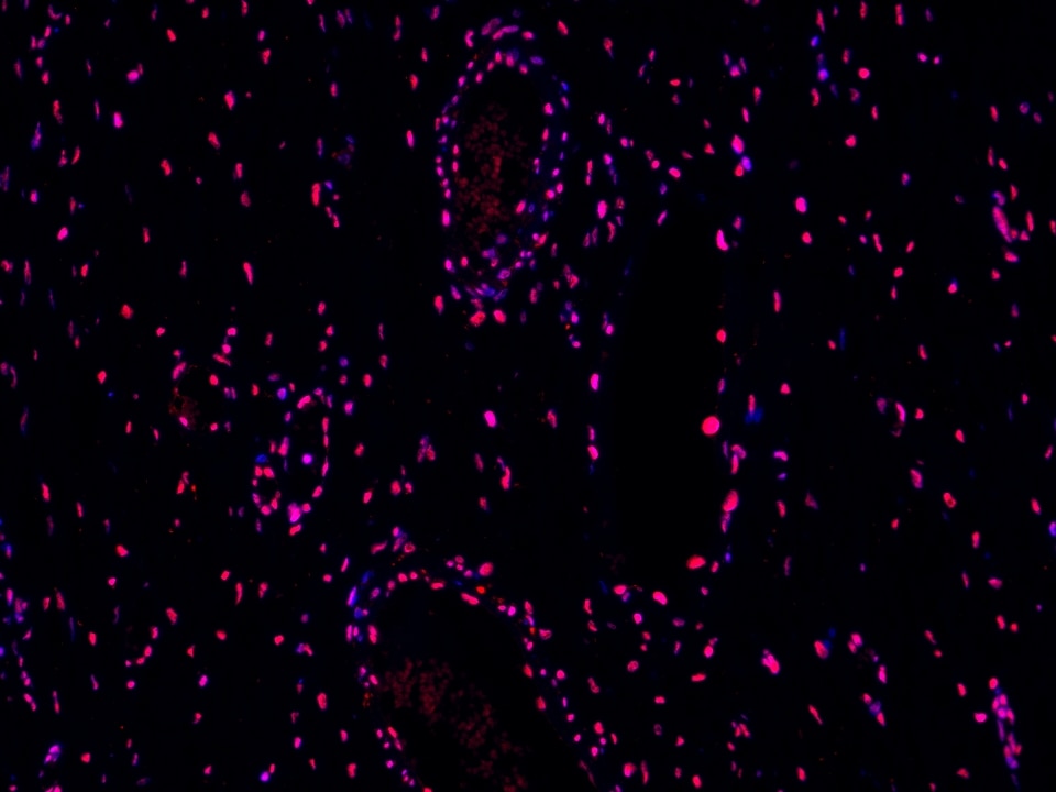 IF Staining using CoraLite®Plus 594-Tyramide Reagent PR30024. 
FFPE-human ovary cancer tissue was stained with 14015-1-AP (STAG1 polyclonal antibody) at 1:1000 followed by detection with Multi-rAb® Polymer HRP-Goat Anti-Rabbit/Mouse Universal Recombinant Secondary Antibody (H+L) (Cat.NO. RGAU011). CoraLite®Plus 594-Tyramide Reagent (Cat.NO. PR30024) was used for signal development. Cell nucleus (blue) was stained with DAPI.