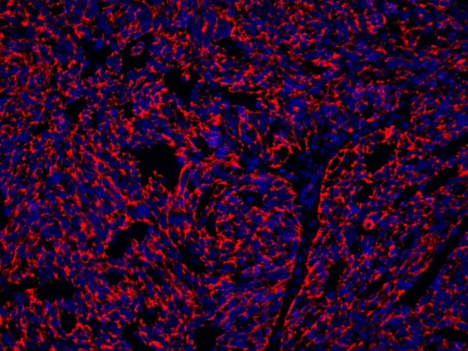 IF Staining using CoraLite®Plus 594-Tyramide Reagent PR30024. 
FFPE-human ovary cancer tissue was stained with 66180-1-Ig (CD71 Monoclonal antibody) at 1:10000 followed by detection with Multi-rAb® Polymer HRP-Goat Anti-Rabbit/Mouse Universal Recombinant Secondary Antibody (H+L) (Cat.NO. RGAU011). CoraLite®Plus 594-Tyramide Reagent (Cat.NO. PR30024) was used for signal development. Cell nucleus (blue) was stained with DAPI. 