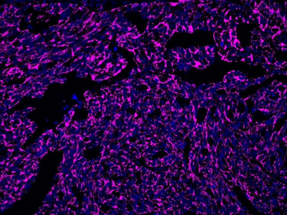IF Staining using CoraLite®Plus 647-Tyramide Reagent PR30025. 
FFPE-human ovary cancer tissue was stained with 66180-1-Ig (CD71 Monoclonal antibody) at 1:10000 followed by detection of Multi-rAb® Polymer HRP-Goat Anti-Rabbit/Mouse Universal Recombinant Secondary Antibody (H+L) (Cat.NO. RGAU011). CoraLite®Plus 647-Tyramide Reagent (Cat.NO. PR30025) was used for signal development. Cell nucleus (blue) was stained with DAPI. 