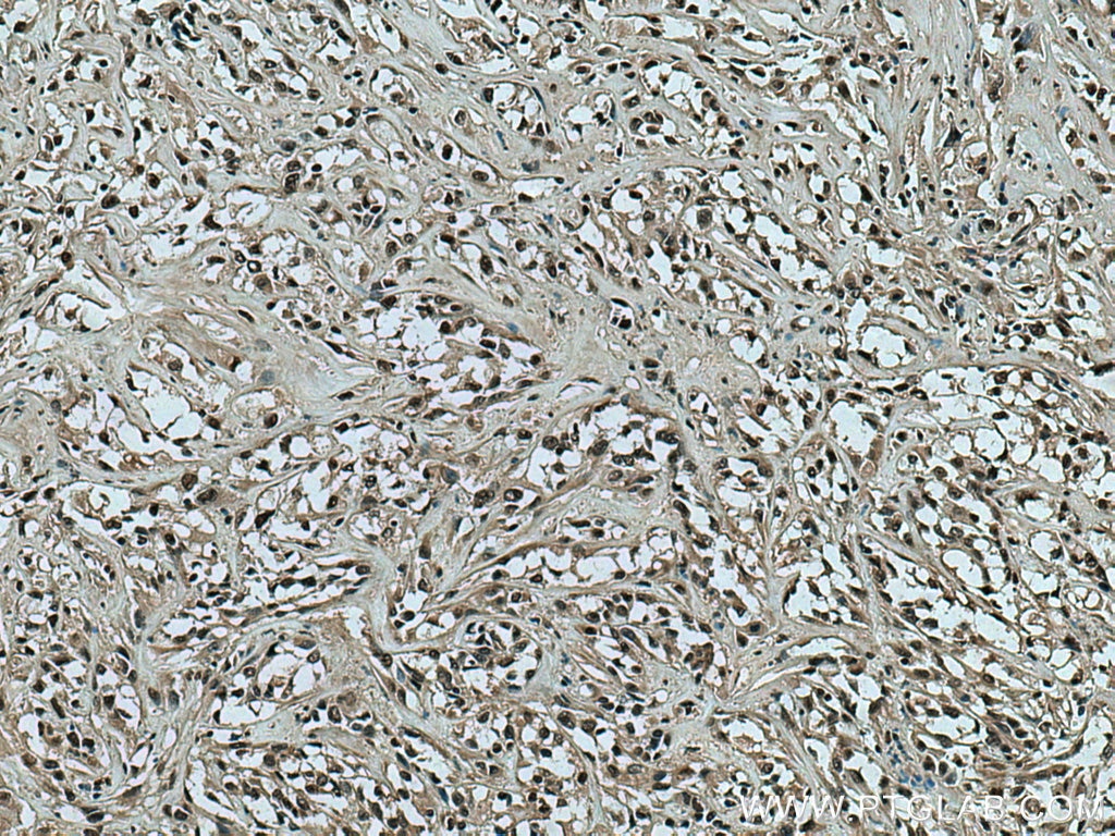Immunohistochemistry (IHC) staining of human renal cell carcinoma tissue using IFI16 Polyclonal antibody (29280-1-AP)