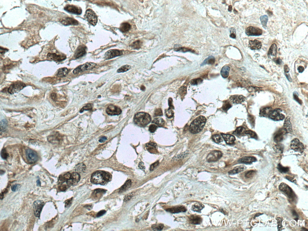 Immunohistochemistry (IHC) staining of human renal cell carcinoma tissue using IFI16 Polyclonal antibody (29280-1-AP)